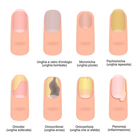 illustrazione di unghie sane e unghie con diverse alterazioni
