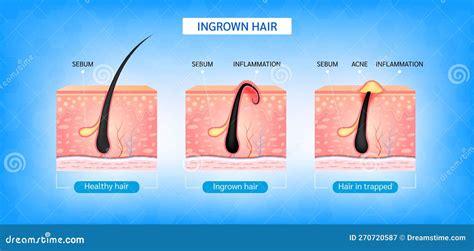 Diagramma di un pelo incarnito sotto la pelle