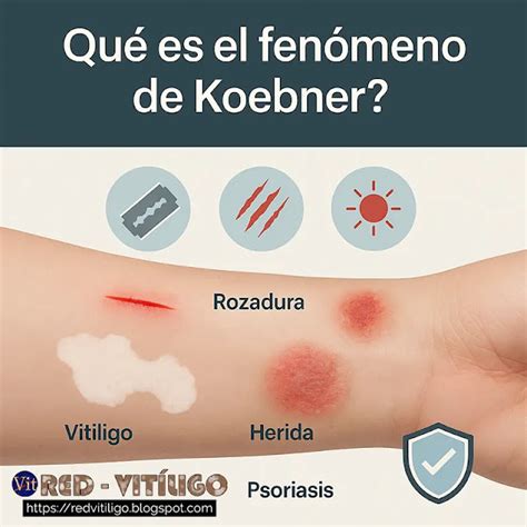 Schema del fenomeno di Koebner nella vitiligine