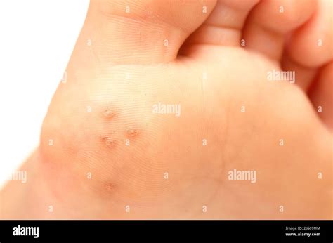 Verruca plantare su un piede di bambino