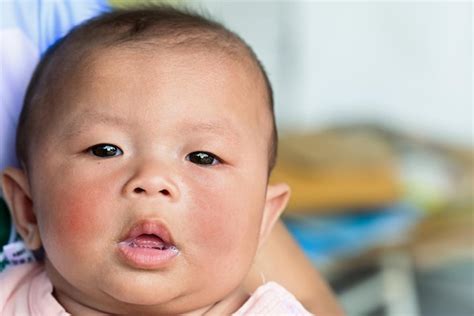 bambino con eczema sul viso