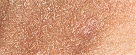 Pelle arrossata e desquamata a causa della psoriasi eritrodermica