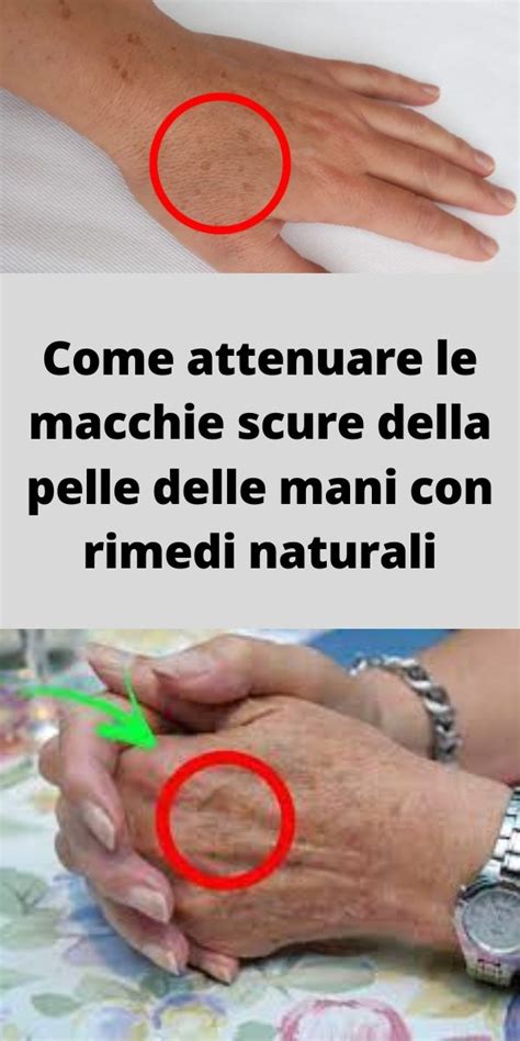 primer piano delle mani con macchie scure