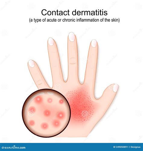 illustrazione di pelle con dermatite da contatto