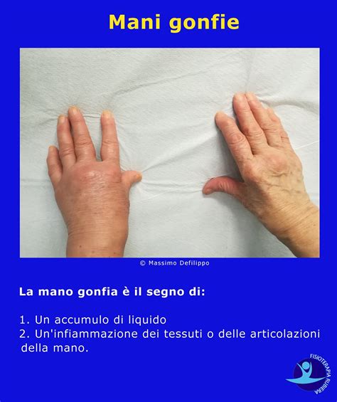 mani gonfie con anelli stretti