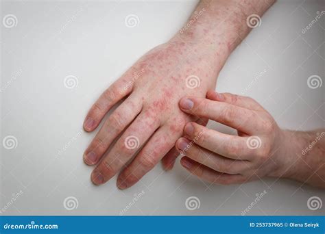 mani con eruzione cutanea pruriginosa