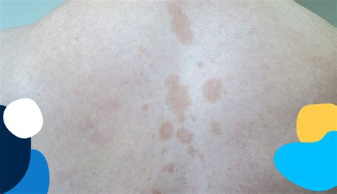 Chiazze di Tinea cruris