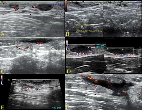 Lesioni da idrosadenite suppurativa