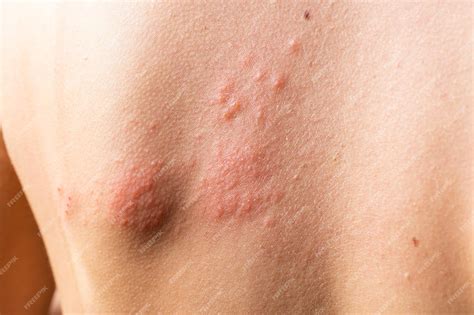 Eruzione cutanea tipica dell'herpes zoster su un dermatomero