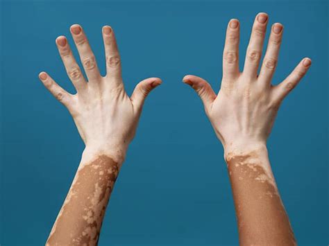 Diagramma che mostra la differenza tra pelle pigmentata e pelle affetta da vitiligine