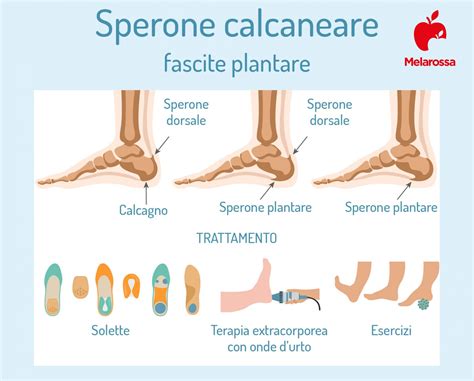 Infografica sui trattamenti per la fascite plantare