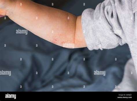 bambino con eczema sulle braccia