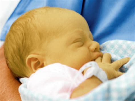 Neonato con ittero fisiologico