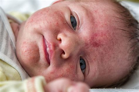 Neonato con acne neonatorum