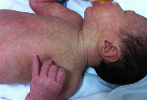 Neonato con cutis marmorata