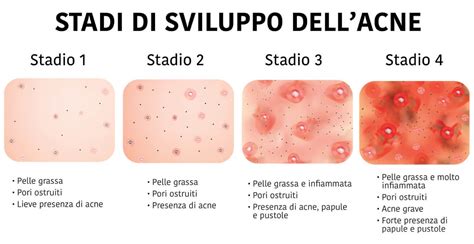 Immagine comparativa di diversi tipi di acne: lieve, moderata, severa (nodulare/conglobata)