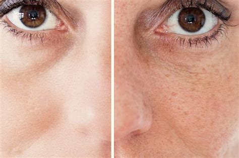 Immagine prima e dopo di un trattamento laser per la rimozione di macchie solari sul viso