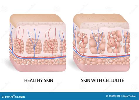 Schema della formazione della cellulite