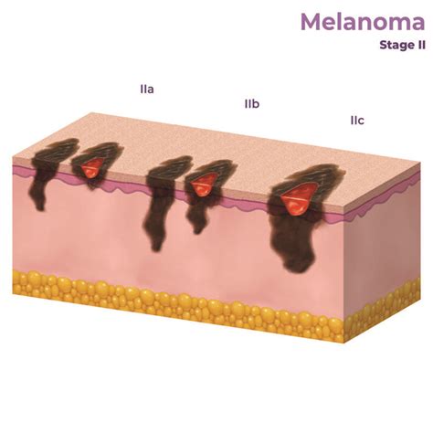 Diagramma che illustra la diffusione del melanoma ai linfonodi