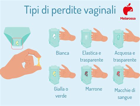 Diagramma delle perdite vaginali e delle loro possibili cause