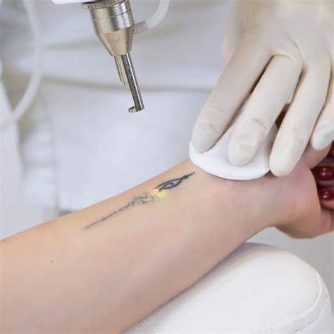Tecnologia laser per la rimozione dei tatuaggi