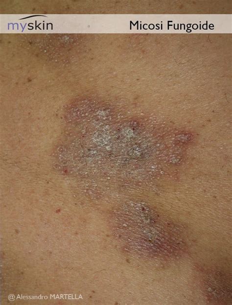 Immagine di chiazze cutanee eritematose e desquamanti, tipiche della fase iniziale della micosi fungoide
