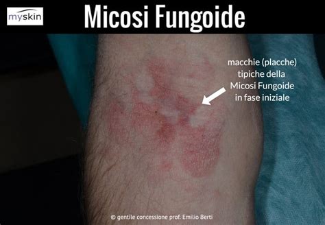 Diagramma che illustra le diverse fasi della micosi fungoide e le relative opzioni terapeutiche