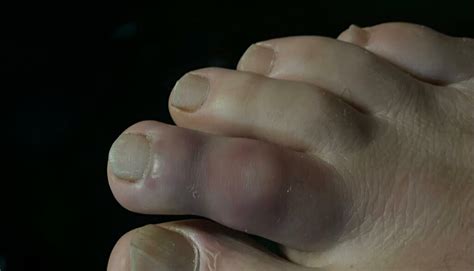 Immagine ravvicinata di un dito del piede con un segno scuro sotto l'unghia, indicativo di un possibile melanoma acrale