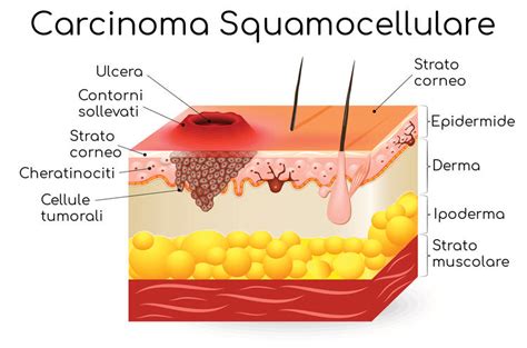 Schema che illustra la progressione da cheratosi attinica a carcinoma squamocellulare