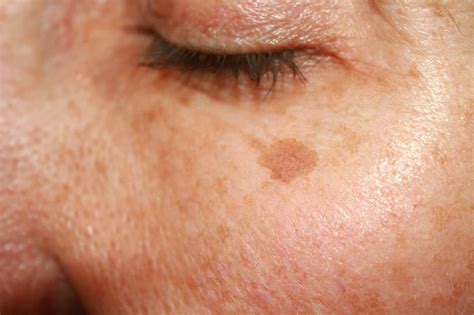 Diverse manifestazioni visive di cheratosi attinica