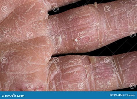 Immagine ravvicinata di un piede con arrossamento e desquamazione, tipici della dermatite da stress