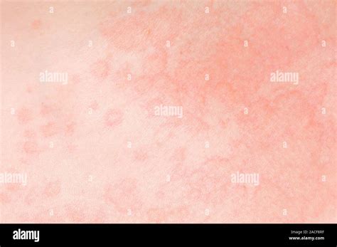 Orticaria pigmentosa su pelle adulta