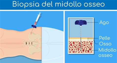 Micrografia di biopsia midollare con mastociti