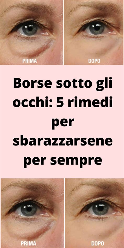 schema delle occhiaie e delle borse sotto gli occhi