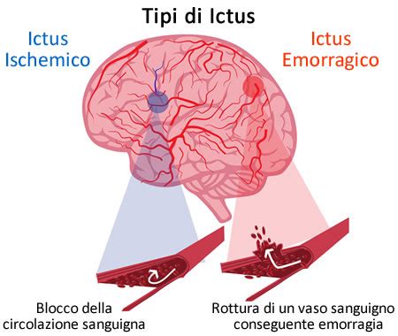 Diagramma che illustra i diversi tipi di ictus