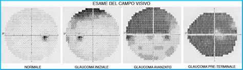 Illustrazione di miodesopsie nel campo visivo