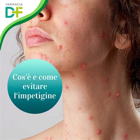 Illustrazione di bolle e croste tipiche dell'impetigine attorno al naso e alla bocca