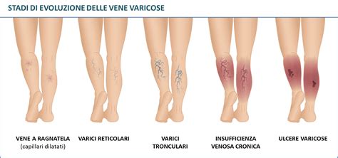 Schema anatomico degli arti inferiori con evidenziazione delle vene varicose e delle ulcere da stasi
