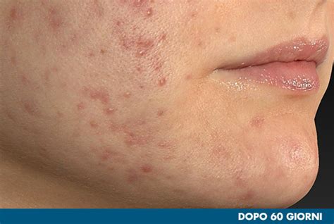 Illustrazione di una pelle con imperfezioni prima e dopo il trattamento con acido salicilico