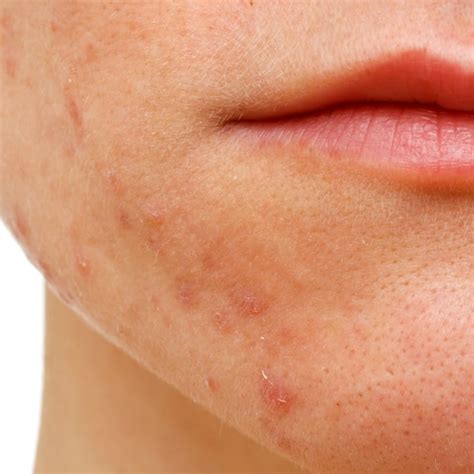 Schema del viso che evidenzia le aree interessate dalla dermatite periorale, inclusi gli angoli del naso e la zona perioculare