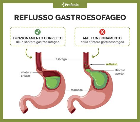 Diagramma del reflusso gastroesofageo verso la laringe