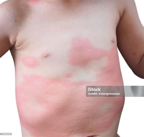 Bambino con eruzione cutanea orticarioide