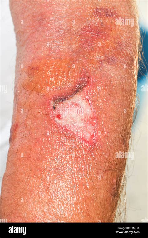 Immagine di una ferita chirurgica infetta con arrossamento e gonfiore