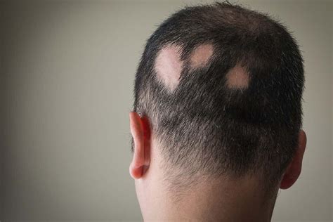 Immagine di una persona con chiazze di alopecia areata sul cuoio capelluto