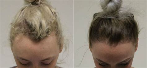 Illustrazione di diversi stili di acconciature che possono causare alopecia da trazione