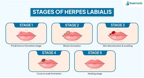 Infographic showing the different mechanisms of action of laser therapy on herpes labialis