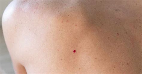 Dettaglio di piccoli puntini rossi-violacei sulla pelle dello scroto