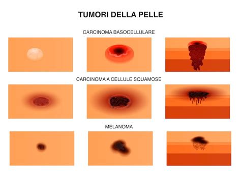 Diagramma che illustra le diverse tipologie di tumori cutanei