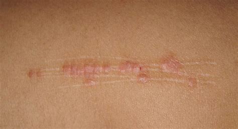 Diagramma che illustra il fenomeno di Koebner