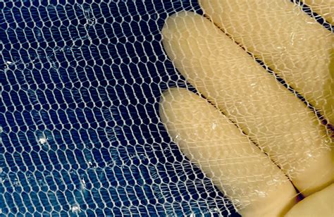 schema di intervento per ernia inguinale con rete protesica